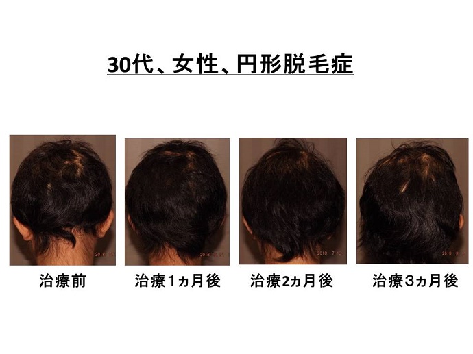 円形脱毛症　病院